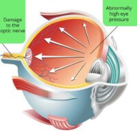 Glaucoma