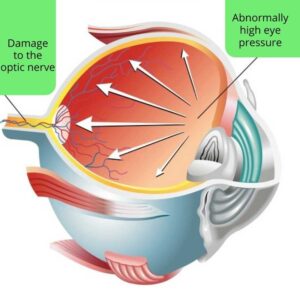 3D image of the eye showing how abnormally high eye pressure damages the optic nerve in glaucoma