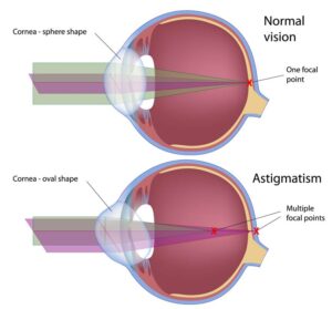 Normal eye versus eye with astigmatism