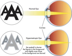 Normal eye versus eye with hyperopia