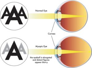 Normal eye versus eye with myopia